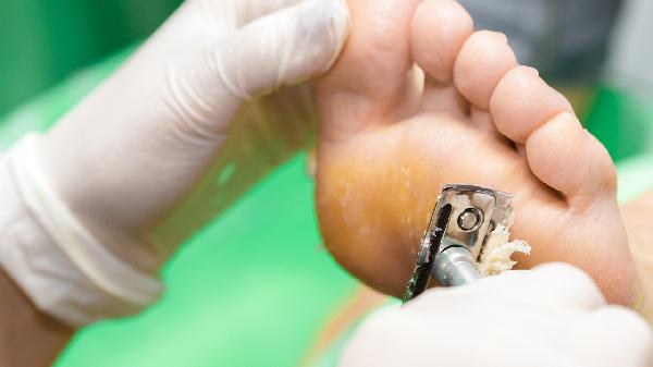 跖疣可以吃消炎药吗