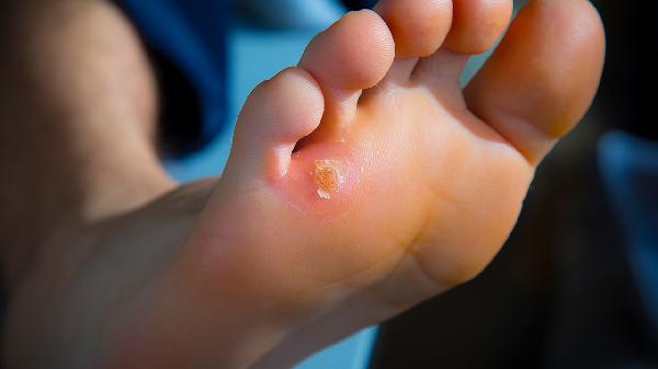 跖疣敷药突然开始疼