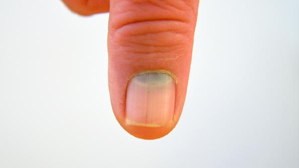 甲周炎用什么药最快好