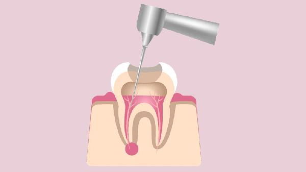 根管治疗封药后胀痛怎么回事