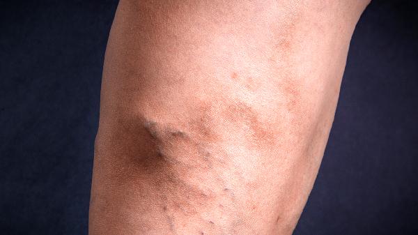 静脉曲张吃什么药