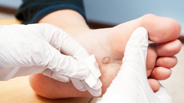 治疗鸡眼的药膏用完之后能洗脚吗