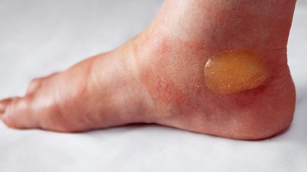 水泡破了涂了几天药局部红肿怎么办