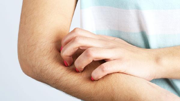 脂溢性皮炎脱擦什么药