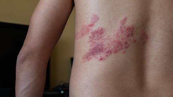 金钱癣应该用什么药物