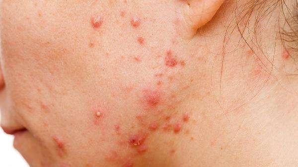 有哪些原因会导致老年斑的产生