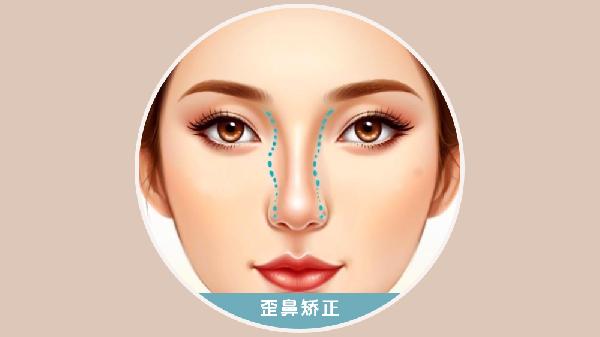 歪鼻矫正应采取什么方法