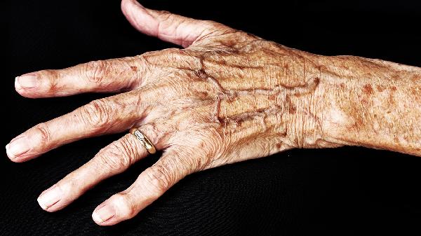 年轻人长老年斑怎么办