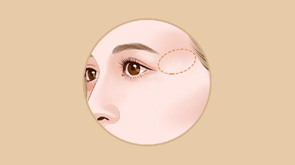 什么是注射玻尿酸丰太阳穴