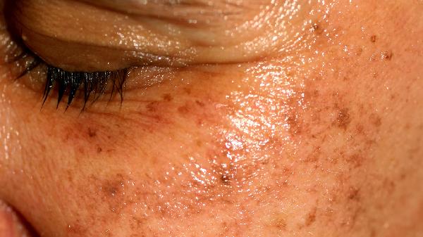 吃什么食物能去老年斑