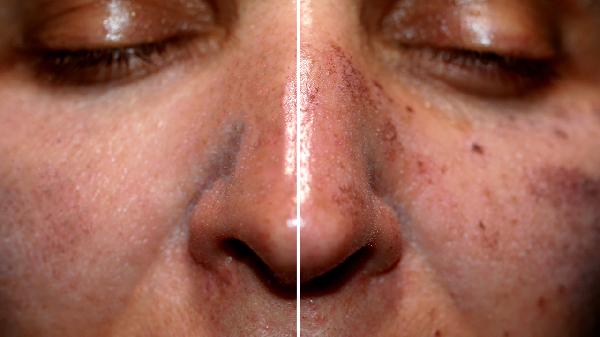 手上老年斑消除最好的方法有哪些