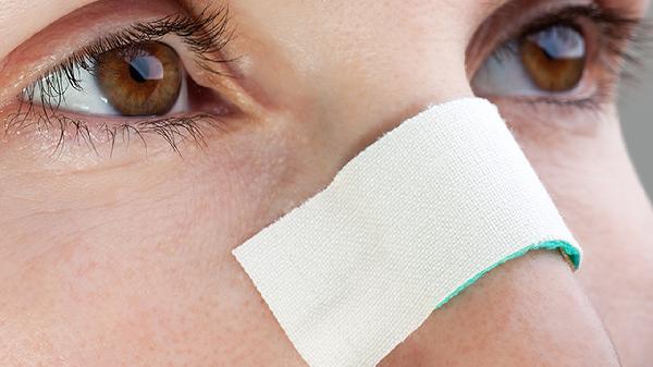 假体鼻子取出的方法