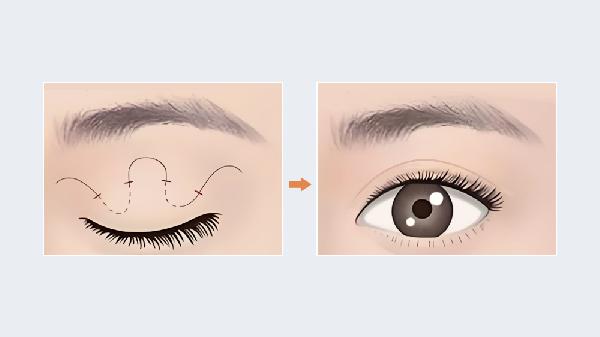 五十岁能做埋线双眼皮吗