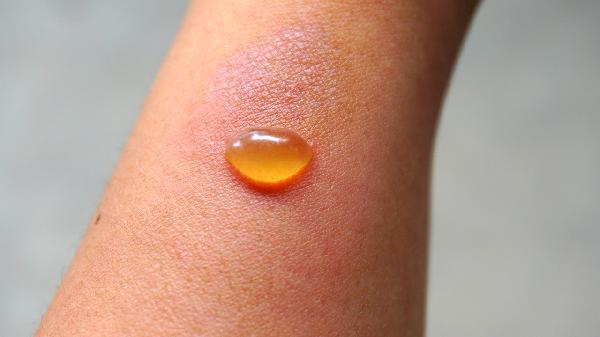 脚有水泡很痒怎么治疗用什么药