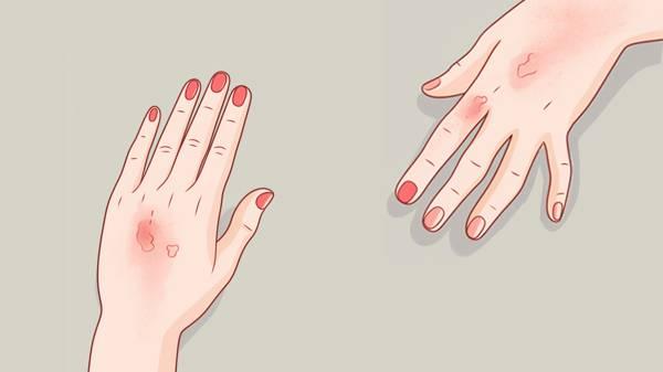 皮肤病血毒丸注意事项有哪些