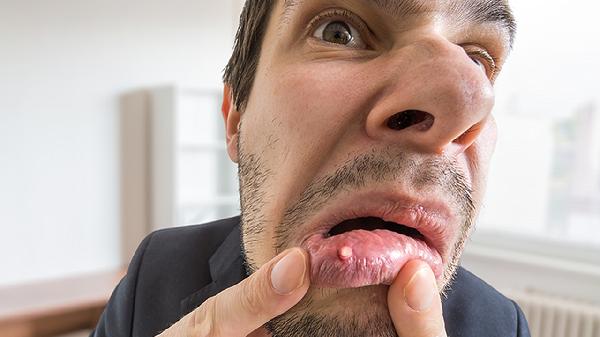 溃疡灵胶囊的作用都有哪些