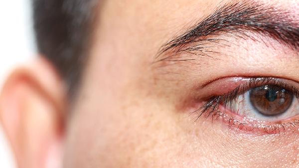 西吡氯铵滴眼液可以治疗什么病