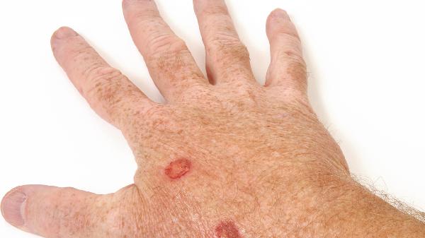 嘴唇上长水泡了怎样快速好起来