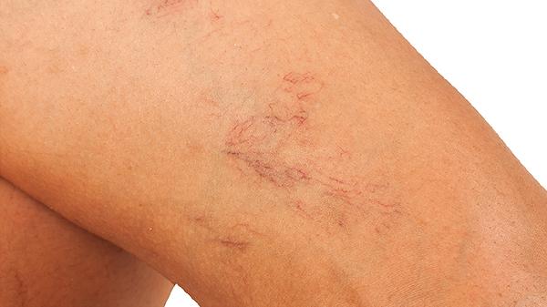 静脉曲张不手术能治好吗