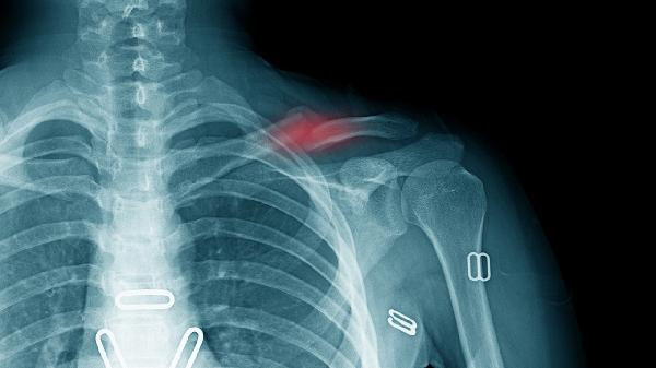 锁骨拆钢板后多久可以恢复