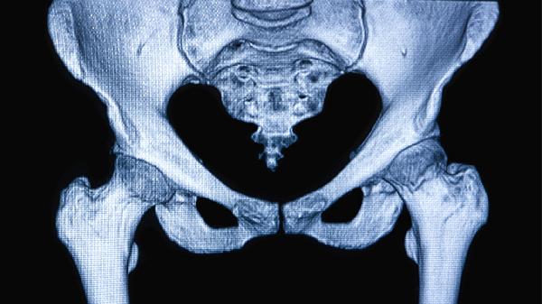 先天性髋骨发育不良怎么办呢