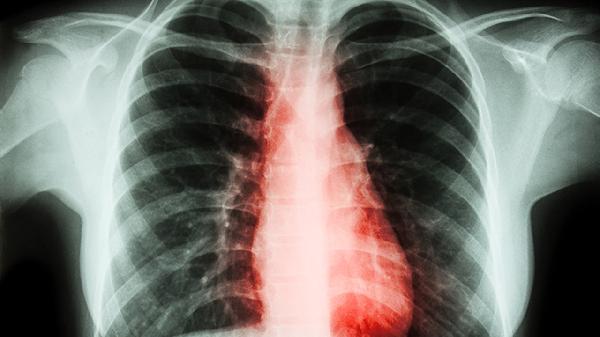 胸椎压迫神经表现