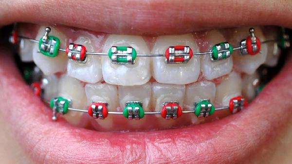 35岁可以做牙齿矫正吗