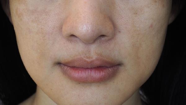 嘴角色素沉着如何祛除