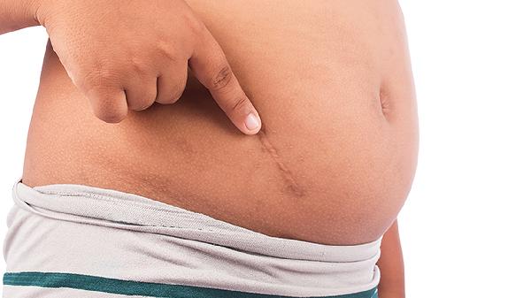 甲状腺癌手术疤痕怎么办