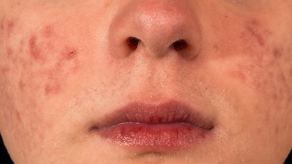 怎样不长老年斑