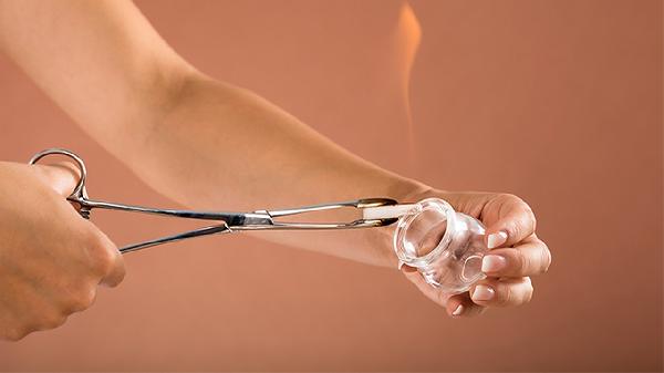 拔罐可以减肥吗