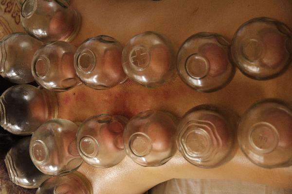 拔罐减肥后必须封罐吗