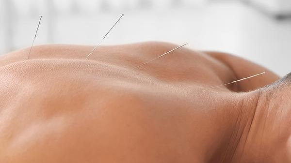 针灸减肥的原理