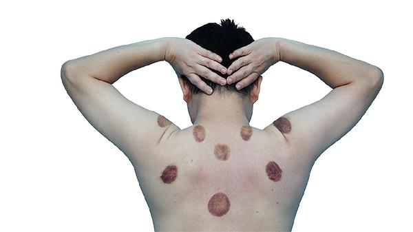 拔罐减肥有用吗