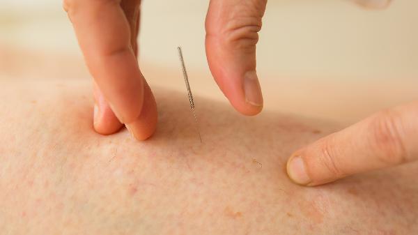 针灸减肥法是什么