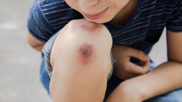 小腿很粗怎么办