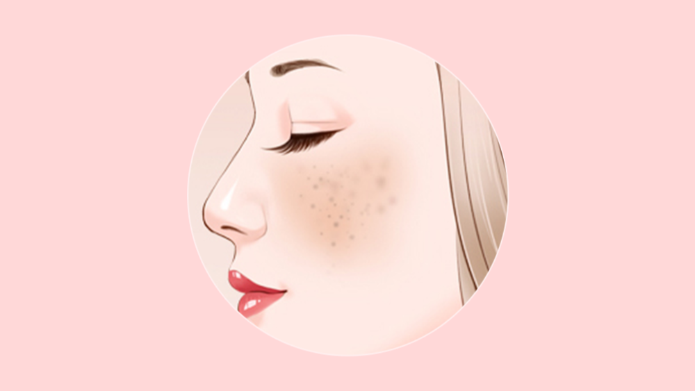 黄褐斑挂中医什么科