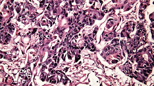重复感染新冠病毒的后果