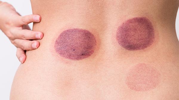 肚子拔罐有好处吗