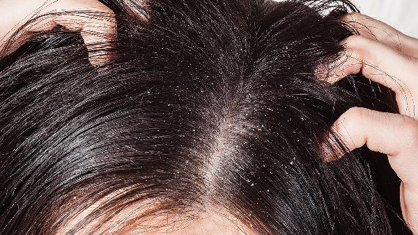 头上头皮屑为什么那么多