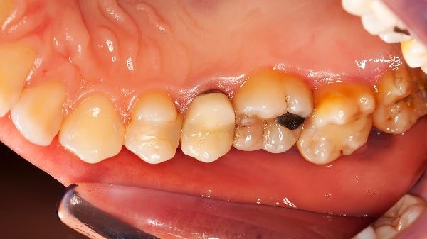 牙齿酸疼是怎么回事是什么原因