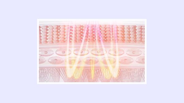 深蓝射频能消掉填充的脂肪吗