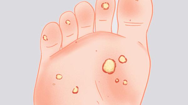 皮肤病血毒片的作用都有哪些