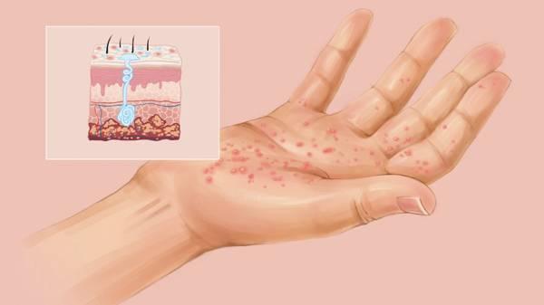 皮肤病血毒丸作用与功效