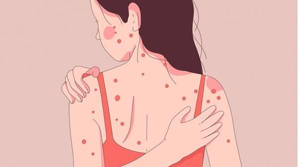 皮肤病血毒片使用时需要注意什么