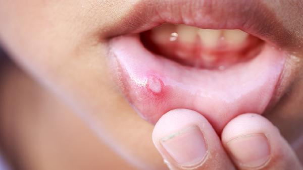 口腔溃疡散的功效有哪些