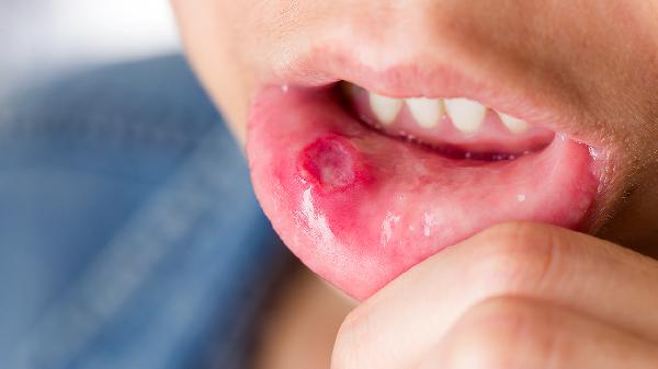 口炎清胶囊作用与功效