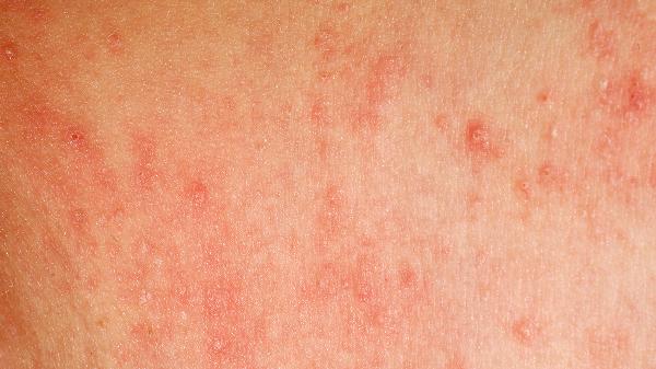 湿毒清胶囊适应人群有哪些