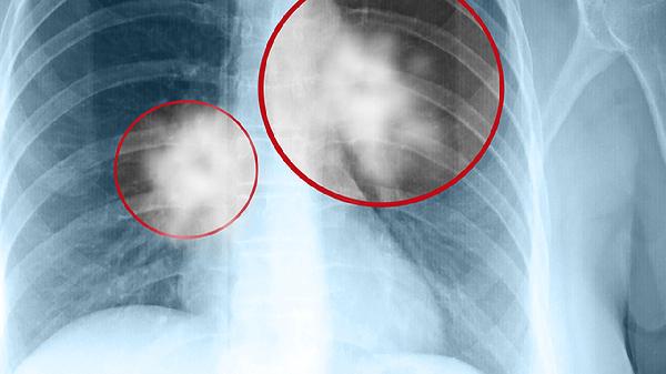 肿瘤六项检查几项高会危险