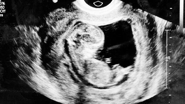 B超能检查什么病